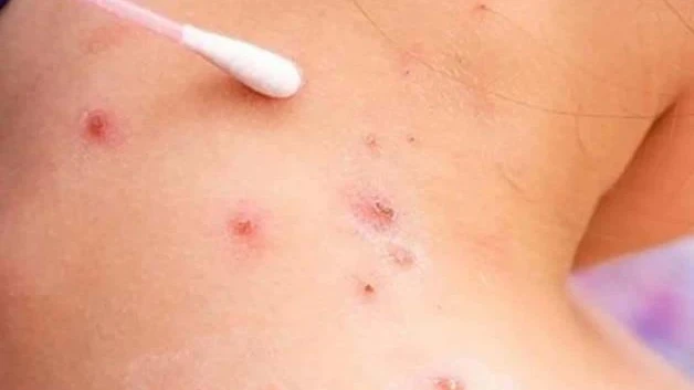 Suben contagios de viruela símica
