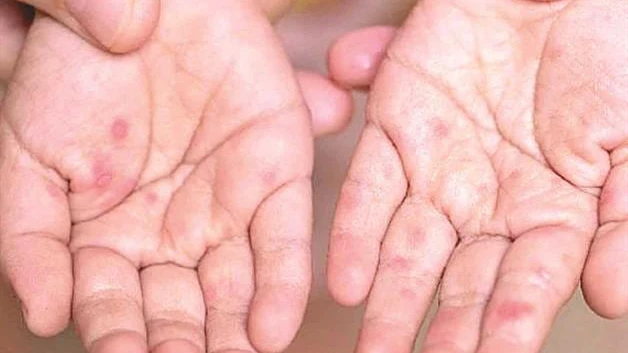 Ataca a niños infección viral; brota en tamaulipas enfermedad ´boca-mano-pie´