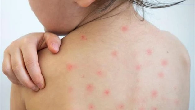 Suma Tamaulipas 12 casos de Sarampión