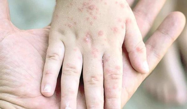 Niegan crisis de sarampión